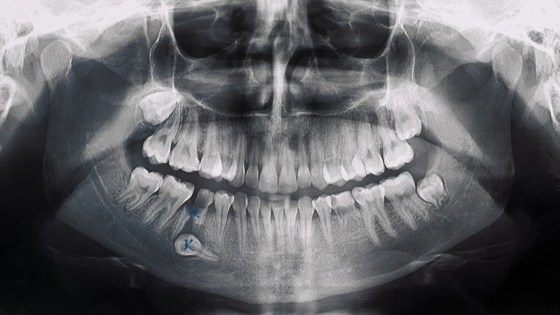 Radiografía dental - Tecnología de precisión Odontokinetica